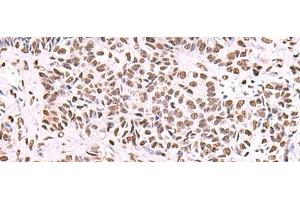 Immunohistochemistry of paraffin-embedded Human ovarian cancer tissue using NASP Polyclonal Antibody at dilution of 1:55(x200) (NASP antibody)