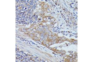 Immunohistochemistry of paraffin-embedded human lung cancer using Cortactin antibody  at dilution of 1:100 (40x lens). (Cortactin antibody  (AA 1-200))