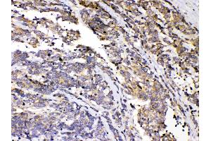 PRKAR1A was detected in paraffin-embedded sections of human lung cancer tissues using rabbit anti- PRKAR1A Antigen Affinity purified polyclonal antibody (Catalog # ) at 1 µg/mL. (PRKAR1A antibody  (AA 2-81))