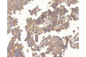 Immunohistochemistry analysis of paraffin-embedded human stomach cancer using TEK Polyclonal Antibody at dilution of 1:200. (TEK antibody)