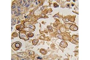 IHC analysis of FFPE human lung carcinoma tissue stained with TLR6 antibody (TLR6 antibody  (AA 722-753))
