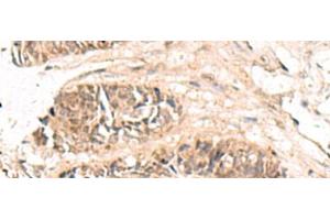 Immunohistochemistry of paraffin-embedded Human colorectal cancer tissue using ABCB4 Polyclonal Antibody at dilution of 1:70(x200) (ABCB4 antibody)