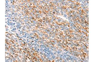 The image on the left is immunohistochemistry of paraffin-embedded Human ovarian cancer tissue using ABIN7192795(THY1 Antibody) at dilution 1/25, on the right is treated with synthetic peptide. (CD90 antibody)