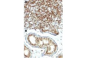 Immunohistochemical staining (Formalin-fixed paraffin-embedded sections) of human rhabdomyosarcoma (A) and human testicular carcinoma (B) with PAX7 monoclonal antibody, clone PAX7/1187 . (PAX7 antibody  (AA 300-600))