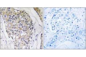 Immunohistochemistry analysis of paraffin-embedded human breast carcinoma tissue, using NDUFS6 Antibody.