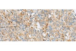 Immunohistochemistry of paraffin-embedded Human cervical cancer tissue using VDAC3 Polyclonal Antibody at dilution of 1:30(x200) (VDAC3 antibody)