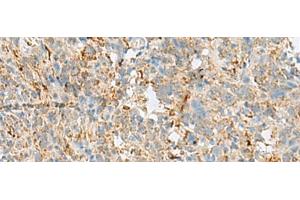 Immunohistochemistry of paraffin-embedded Human cervical cancer tissue using VDAC3 Polyclonal Antibody at dilution of 1:30(x200) (VDAC3 antibody)