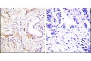 Immunohistochemistry analysis of paraffin-embedded human lung carcinoma tissue, using PIAS3 Antibody. (PIAS3 antibody  (AA 10-59))