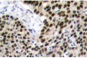 Immunohistochemistry (IHC) analyzes of HSF1 antibody in paraffin-embedded human breast carcinoma tissue. (HSF1 antibody)