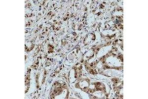 Immunohistochemical analysis of GAPDH staining in human breast cancer formalin fixed paraffin embedded tissue section. (GAPDH antibody)