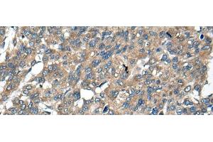 Immunohistochemistry of paraffin-embedded Human liver cancer tissue using BCL2L2 Polyclonal Antibody at dilution of 1:40(x200) (BCL2L2 antibody)