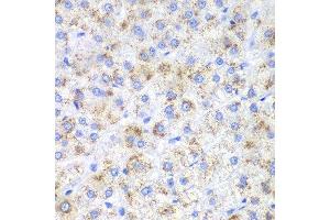 Immunohistochemistry of paraffin-embedded human liver cancer using HAO1 antibody. (HAO1 antibody  (AA 1-370))