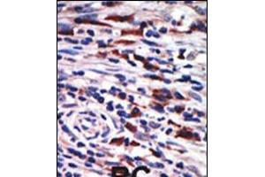 Formalin-fixed and paraffin-embedded human cancer tissue reacted with the primary antibody, which was peroxidase-conjugated to the secondary antibody, followed by AEC staining. (PKC eta antibody  (N-Term))