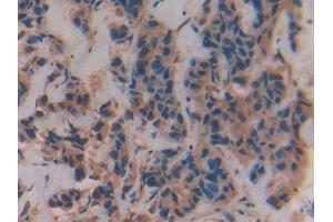 Detection of VAV3 in Human Breast cancer Tissue using Polyclonal Antibody to Vav 3 Oncogene (VAV3) (VAV3 antibody  (AA 183-380))