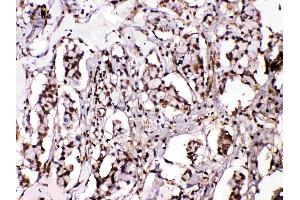 Islet 1 was detected in paraffin-embedded sections of human mammary cancer tissues using rabbit anti- Islet 1 Antigen Affinity purified polyclonal antibody (Catalog # ) at 1 µg/mL.