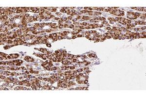 ABIN6272458 at 1/100 staining Human liver cancer tissue by IHC-P. (Vomeronasal 1 Receptor 3 (VMN1R3) antibody)