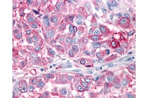 Anti-NPY1R antibody IHC of human Skin, Melanoma. (NPY1R antibody  (Cytoplasmic Domain))
