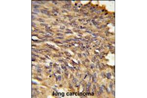 Formalin-fixed and paraffin-embedded human lung carcinoma reacted with HDLBP Antibody , which was peroxidase-conjugated to the secondary antibody, followed by DAB staining. (HDLBP antibody  (AA 764-791))