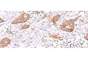 Immunohistochemistry of paraffin-embedded Human esophagus cancer tissue using SASH1 Polyclonal Antibody at dilution of 1:30(x200) (SASH1 antibody)