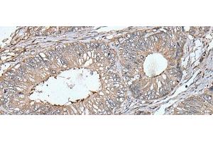 Immunohistochemistry of paraffin-embedded Human colorectal cancer tissue using UNC13B Polyclonal Antibody at dilution of 1:40(x200) (UNC13B antibody)