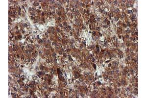Immunohistochemical staining of paraffin-embedded Carcinoma of Human liver tissue using anti-EPM2AIP1 mouse monoclonal antibody. (EPM2AIP1 antibody)
