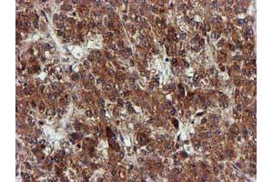 Immunohistochemical staining of paraffin-embedded Carcinoma of Human liver tissue using anti-EPM2AIP1 mouse monoclonal antibody. (EPM2AIP1 antibody)