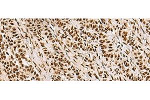 Immunohistochemistry of paraffin-embedded Human ovarian cancer tissue using FOXI1 Polyclonal Antibody at dilution of 1:55(x200) (FOXI1 antibody)