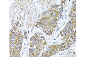 Immunohistochemistry of paraffin-embedded Human prostate cancer using PEX14 Polyclonal Antibody at dilution of 1:100 (40x lens). (PEX14 antibody)