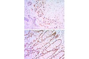 Immunohistochemical analysis of paraffin-embedded human lung cancer tissues (upper) and human rectum tissues (bottom) using KLF4 monoclonal antibody, clone 1E5  with DAB staining. (KLF4 antibody)