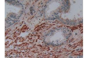 Detection of PLAP in Human Prostate Gland Tissue using Polyclonal Antibody to Phospholipase A2 Activating Protein (PLAP) (PLAA antibody  (AA 162-312))