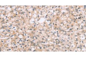 Immunohistochemistry of paraffin-embedded Human prostate cancer tissue using ROR1 Polyclonal Antibody at dilution 1:45 (ROR1 antibody)