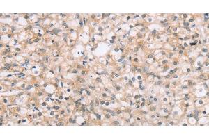 Immunohistochemistry of paraffin-embedded Human prostate cancer tissue using ROR1 Polyclonal Antibody at dilution 1:45 (ROR1 antibody)