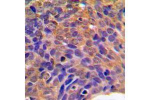 Immunohistochemical analysis of Beta-catenin staining in human breast cancer formalin fixed paraffin embedded tissue section. (beta Catenin antibody  (C-Term))