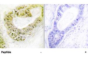 Immunohistochemistry analysis of paraffin-embedded human colon carcinoma tissue using ZNF638 polyclonal antibody .