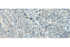 Immunohistochemistry of paraffin-embedded Human ovarian cancer tissue using NPVF Polyclonal Antibody at dilution of 1:80(x200) (NPVF antibody)