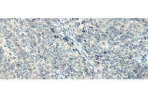 Immunohistochemistry of paraffin-embedded Human ovarian cancer tissue using NPVF Polyclonal Antibody at dilution of 1:80(x200)
