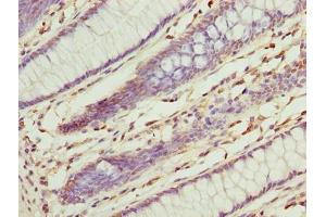 Immunohistochemistry of paraffin-embedded human colon cancer using ABIN7142940 at dilution of 1:100 (ILVBL antibody  (AA 45-344))