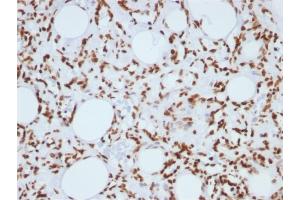 Formalin-fixed, paraffin-embedded human Angiosarcoma stained with Histone H1 Mouse Monoclonal Antibody (1415-1) (Histone H1 antibody)