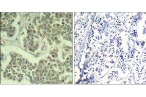 Immunohistochemical analysis of paraffin-embedded human breast carcinoma tissue using eIF2α (phospho-Ser49) Antibody (E011511). (EIF2A antibody  (pSer49))