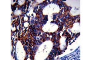 TGFB2 antibody analysis in formalin fixed and paraffin embedded human breast carcinoma.
