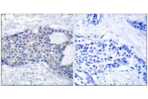 Immunohistochemical analysis of paraffin-embedded human breast carcinoma tissue, using Zap-70 (phospho-Tyr493) antibody (E011160). (ZAP70 antibody  (pTyr493))