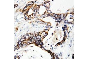 IHC-P: uPAR antibody testing of human breast cancer tissue (uPAR uPA Receptor (C-Term) antibody)