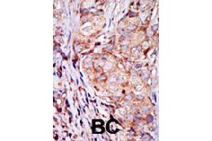 Formalin-fixed and paraffin-embedded human breast cancer tissue reacted with TRIB3 polyclonal antibody  , which was peroxidase-conjugated to the secondary antibody, followed by AEC staining. (TRIB3 antibody  (N-Term))