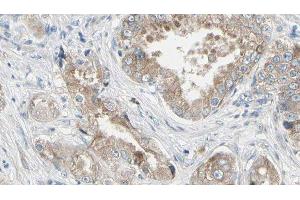 ABIN6279342 at 1/100 staining Human prostate tissue by IHC-P. (PLA2G4F antibody  (C-Term))