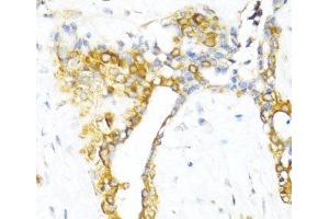Immunohistochemistry of paraffin-embedded Human breast using CTGF Polyclonal Antibody at dilution of 1:100 (40x lens). (CTGF antibody)