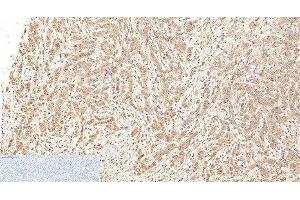 Immunohistochemistry of paraffin-embedded Human breast cancer tissue using Cleaved-CASP1 (D210) Polyclonal Antibody at dilution of 1:200. (Caspase 1 antibody  (Cleaved-Asp210))