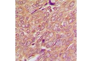 Immunohistochemical analysis of SREBP1 staining in human breast cancer formalin fixed paraffin embedded tissue section. (SREBF1 antibody)