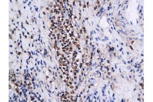 Formalin-fixed and paraffin embedded human cervical intraepithelial xenografts labeled with Anti-Annexin A1 Polyclonal Antibody, Unconjugated (ABIN731378) followed by conjugation to the secondary antibody and DAB staining (Annexin a1 antibody  (AA 281-346))