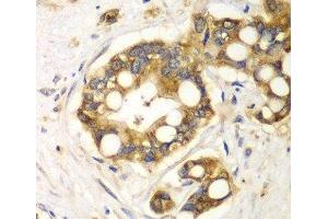 Immunohistochemistry of paraffin-embedded Human liver cancer using RPH3A Polyclonal Antibody at dilution of 1:100 (40x lens).