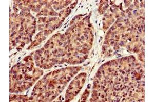 Immunohistochemistry of paraffin-embedded human ovarian cancer using ABIN7166771 at dilution of 1:100 (RBFA antibody  (AA 201-343))